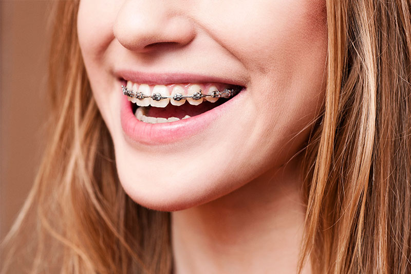 Phase I Orthodontics in Palm Harbor